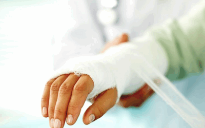 5th Metacarpal Fracture
