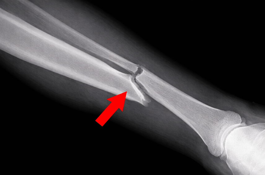 Fibula Fracture Treatment Clinic Gold Coast Brisbane Symptoms Causes of fractured Fibula 