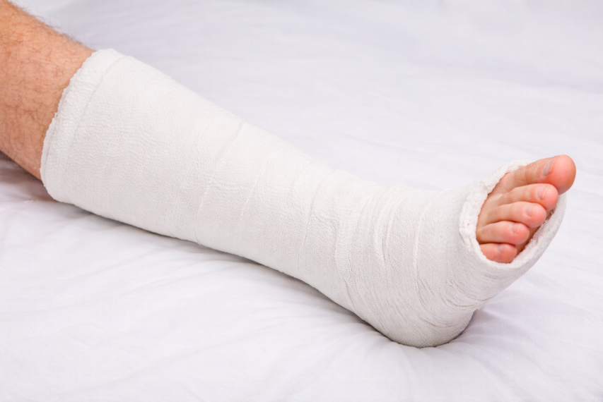 Fibula Fracture Treatment Clinic Near Me Brisbane Gold Coast Queensland