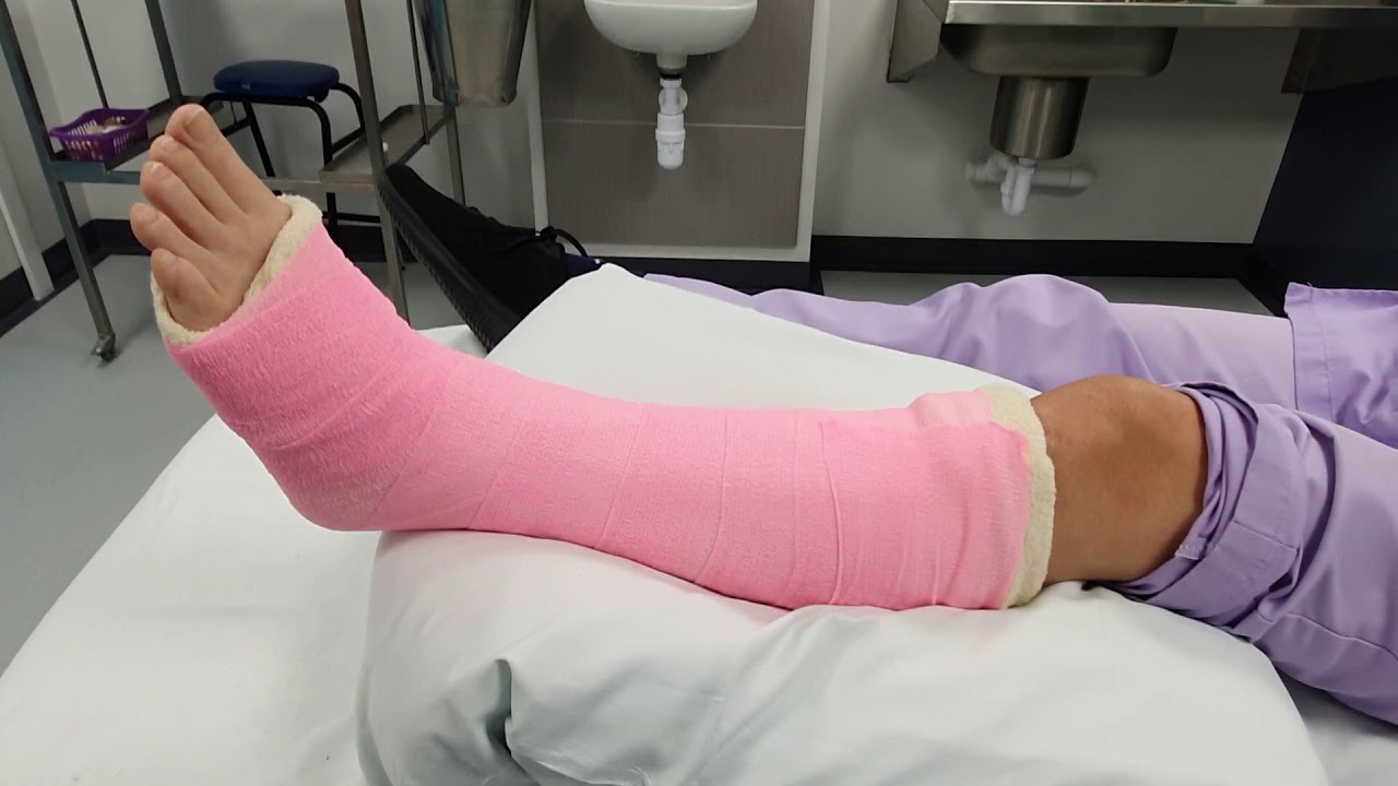 Fibula Fracture Treatment Clinic Near Me Brisbane Gold Coast Queensland