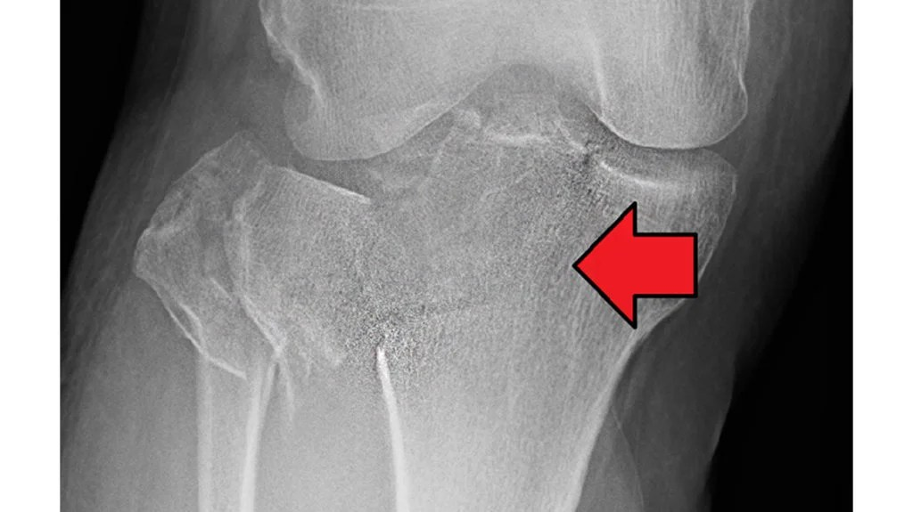 Fibula Fracture Treatment Clinic Gold Coast Brisbane Symptoms Causes of fractured Fibula 