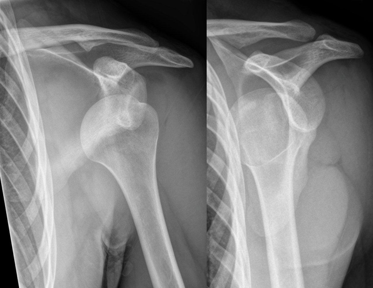 Fibula Fracture Treatment Clinic Gold Coast Brisbane Symptoms Causes of fractured Fibula 