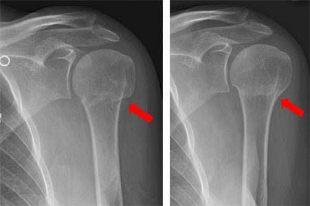 Fibula Fracture Treatment Clinic Gold Coast Brisbane Symptoms Causes of fractured Fibula 