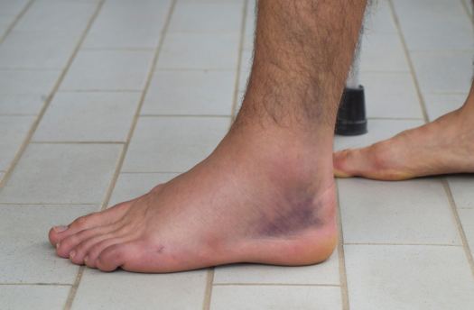 Fibula Fracture Treatment Clinic Gold Coast Brisbane Symptoms Causes of fractured Fibula 