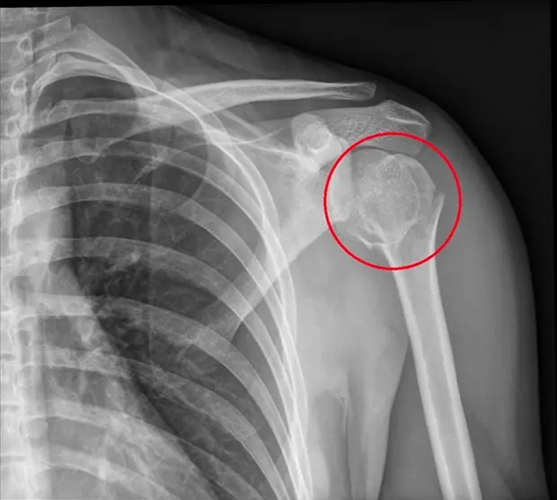 Fibula Fracture Treatment Clinic Gold Coast Brisbane Symptoms Causes of fractured Fibula 