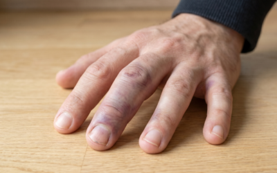 Jammed Finger or Fracture? Signs, First Aid & When to Get it Checked
