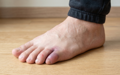 Broken toe vs sprained toe: signs, treatment, and when to seek urgent care (AU)